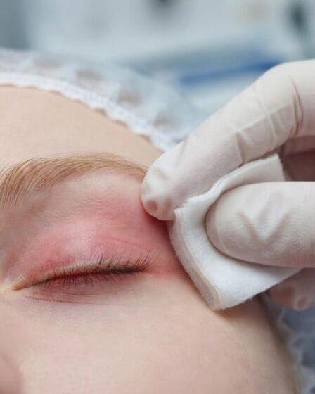 Zapalenie brzegów powiek (blepharitis): objawy i leczenie