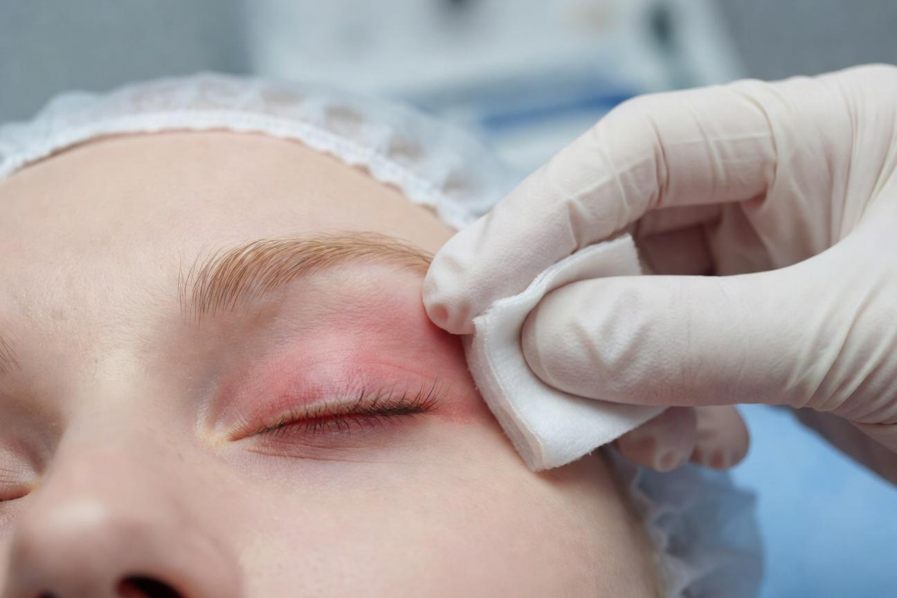 Zapalenie brzegów powiek (blepharitis): objawy i leczenie